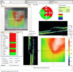 oct occlusion veineuse veinous mapping