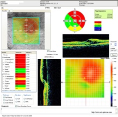 occlusion branche veine mapping vein occlusion retine retina oct optovue