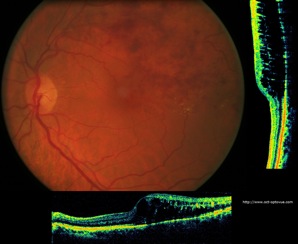 oct occlusion veineuse veinous