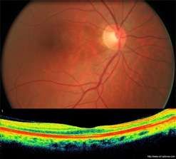 oct occlusion artère cilio retinienne