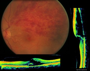 occlusion branche veine centrale retine vein occlusion retina oct optovue