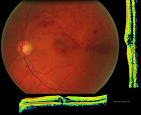 oct venous thrombosis retina occlusion veineuse rétine