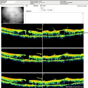 ovcr oedeme retine retina oedema occlusion oct optovue