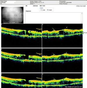 ovcr oedeme retine retina oedema occlusion oct optovue