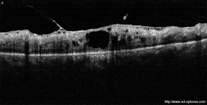 occlusion veine centrale retine retina oct optovue