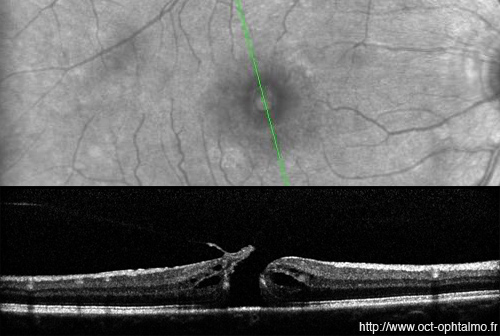 trou maculaire sanotek spectralis heildelberg